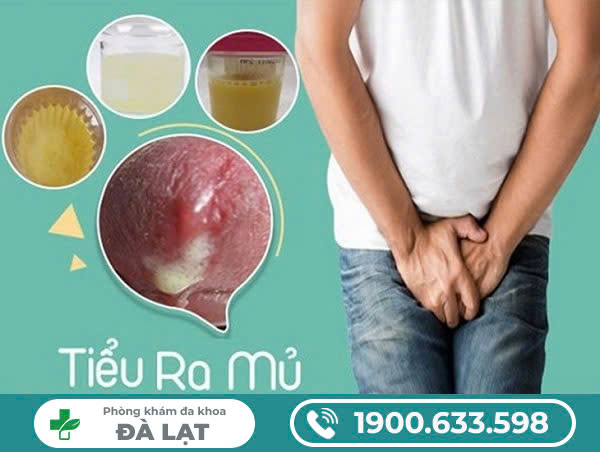 Tiểu buốt, tiều ra mủ - Dấu hiệu cảnh báo nhiều bệnh lý nguy hiểm ở nữ giới